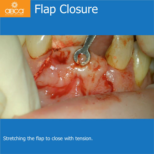 Upper Central Incisors, Augmentation and Implants