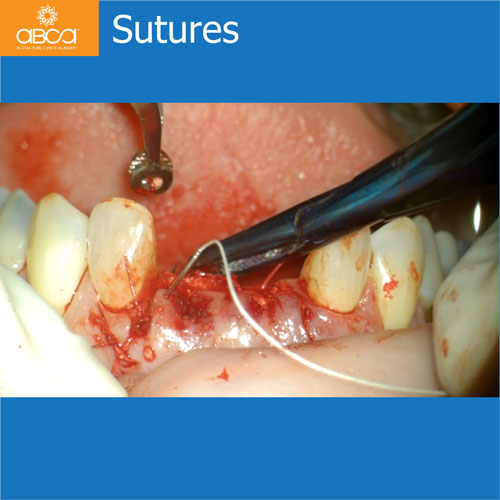 Upper Central Incisors, Augmentation and Implants