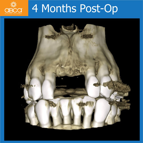 Upper Central Incisors, Augmentation and Implants