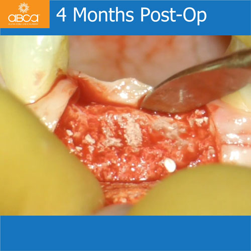 Upper Central Incisors, Augmentation and Implants