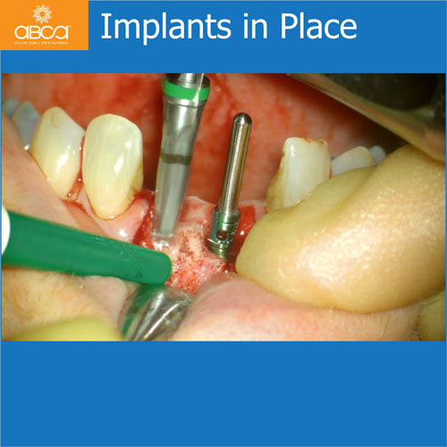 Upper Central Incisors, Augmentation and Implants