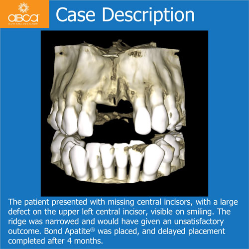 Upper Central Incisors, Augmentation and Implants