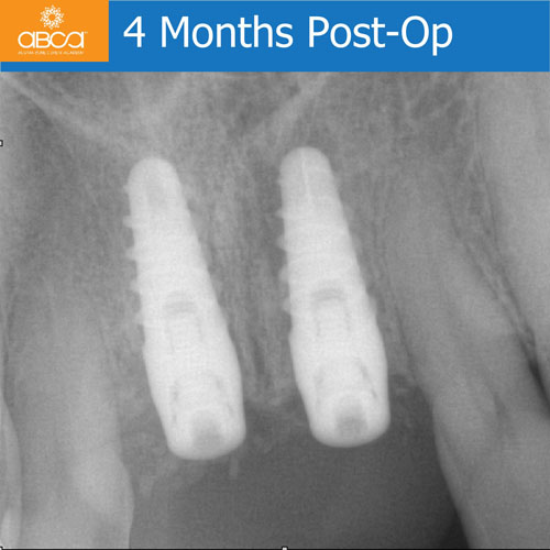 Upper Central Incisors, Augmentation and Implants