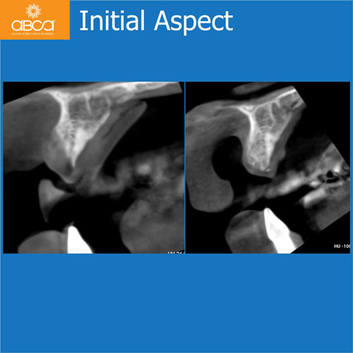 Upper Central Incisors, Augmentation and Implants