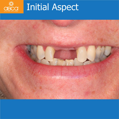 Upper Central Incisors, Augmentation and Implants