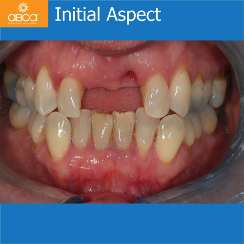 Upper Central Incisors, Augmentation and Implants