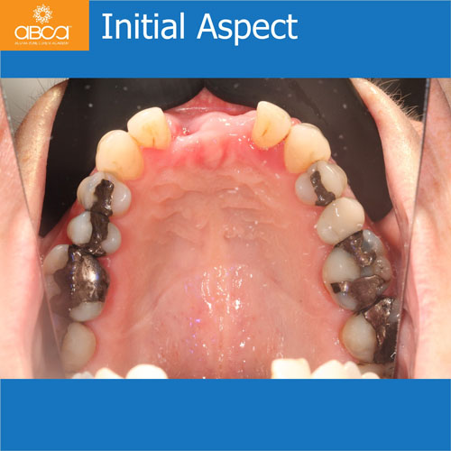 Upper Central Incisors, Augmentation and Implants