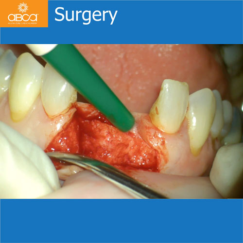 Upper Central Incisors, Augmentation and Implants