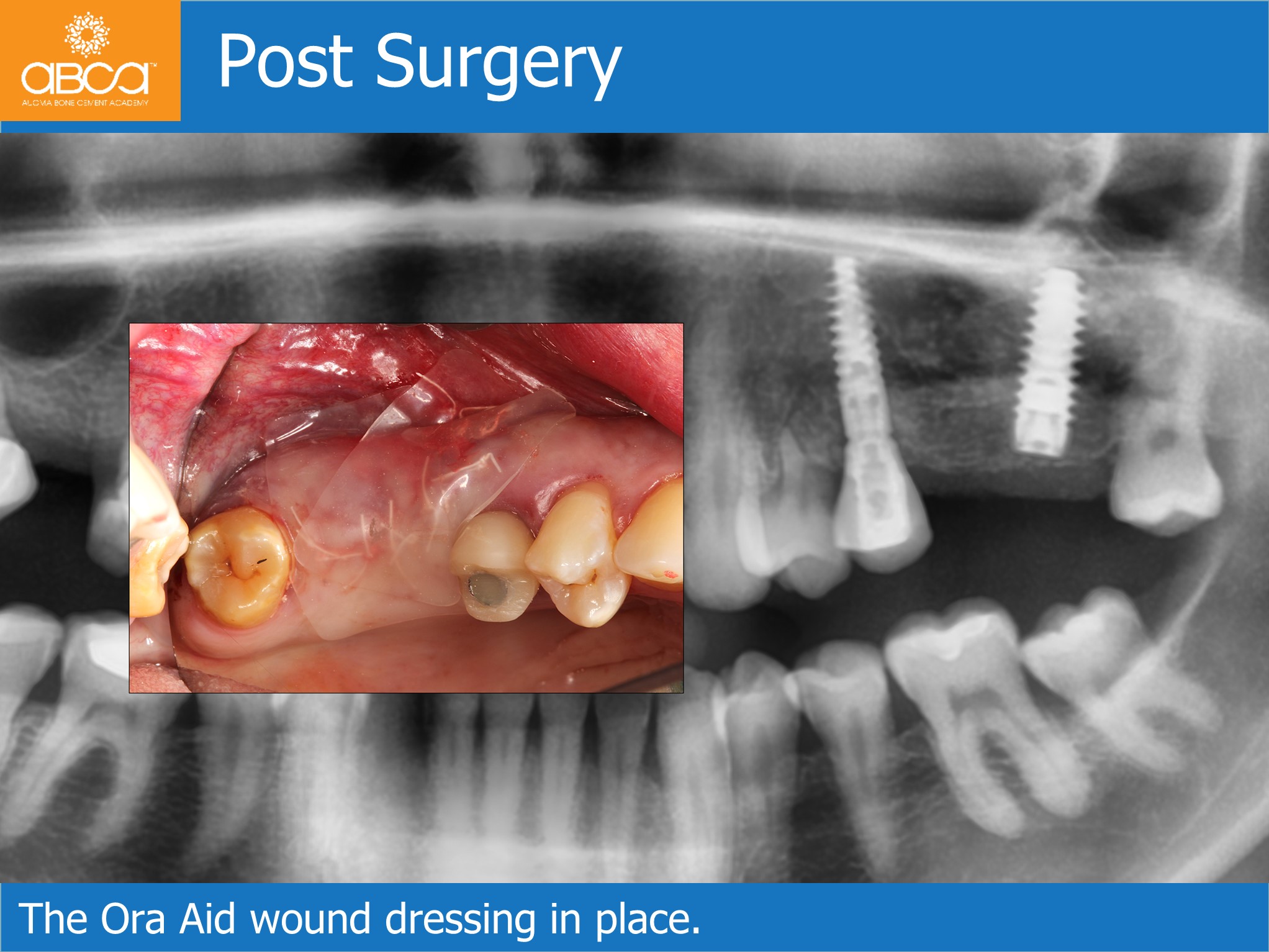 Sinus lift for implant prep near me