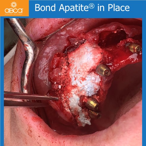 The Impossible Case: No Bone, No Tissue, No Bite