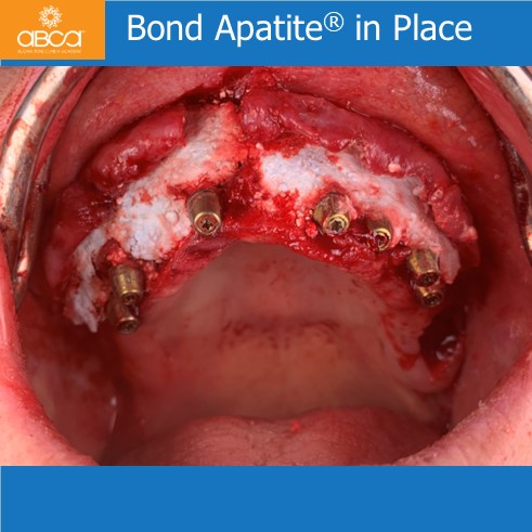 The Impossible Case: No Bone, No Tissue, No Bite