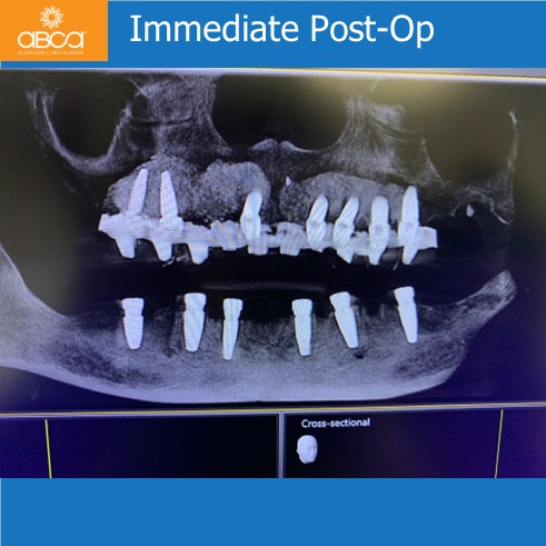 The Impossible Case: No Bone, No Tissue, No Bite
