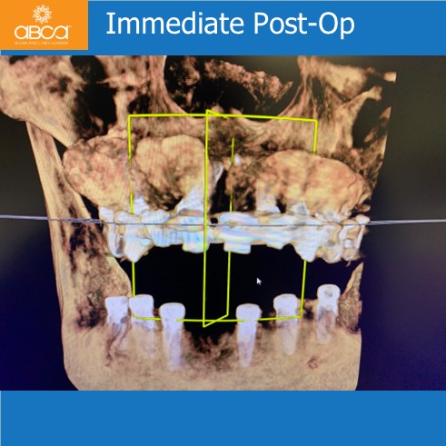 The Impossible Case: No Bone, No Tissue, No Bite