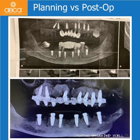 The Impossible Case: No Bone, No Tissue, No Bite