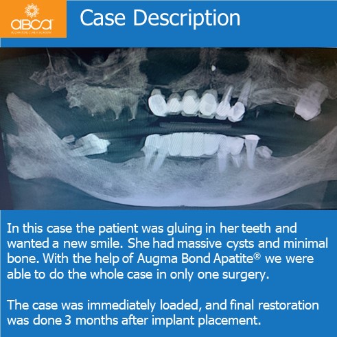 The Impossible Case: No Bone, No Tissue, No Bite