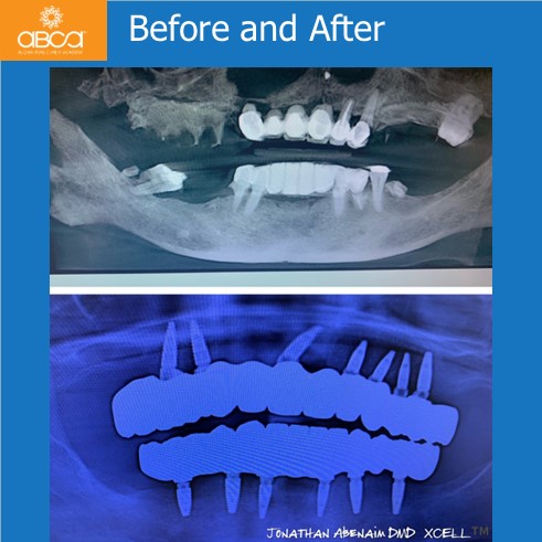 The Impossible Case: No Bone, No Tissue, No Bite