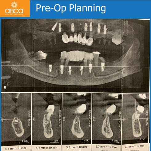 The Impossible Case: No Bone, No Tissue, No Bite