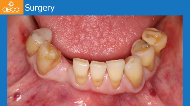 Mandible Full Arch Rehabilitation with an Immediate All-on-5 and Immediate Load