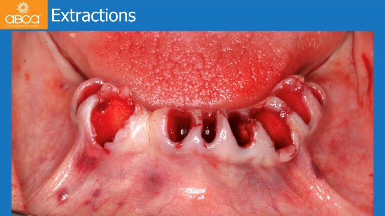 Mandible Full Arch Rehabilitation with an Immediate All-on-5 and Immediate Load