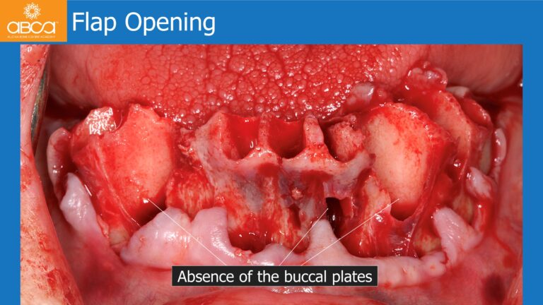 Mandible Full Arch Rehabilitation with an Immediate All-on-5 and Immediate Load