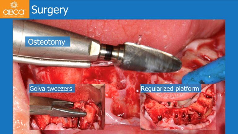 Mandible Full Arch Rehabilitation with an Immediate All-on-5 and Immediate Load