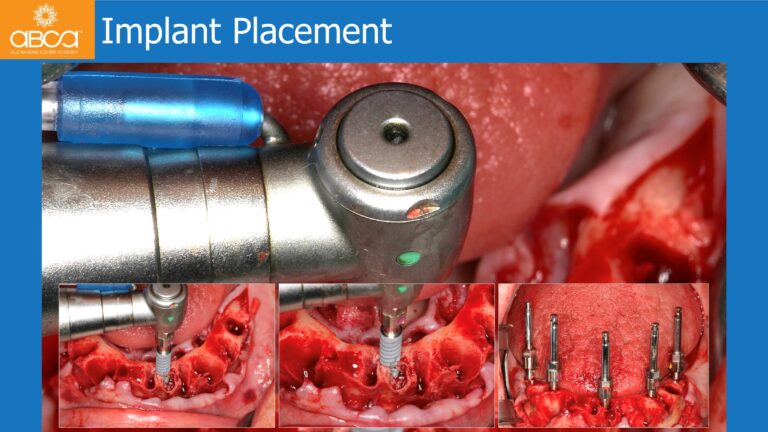 Mandible Full Arch Rehabilitation with an Immediate All-on-5 and Immediate Load