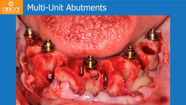 Mandible Full Arch Rehabilitation with an Immediate All-on-5 and Immediate Load