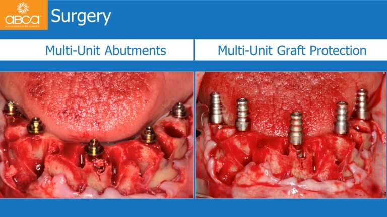 Mandible Full Arch Rehabilitation with an Immediate All-on-5 and Immediate Load