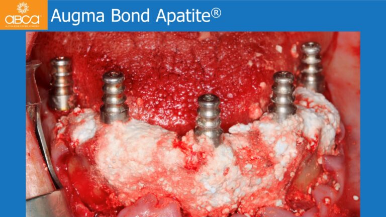 Mandible Full Arch Rehabilitation with an Immediate All-on-5 and Immediate Load