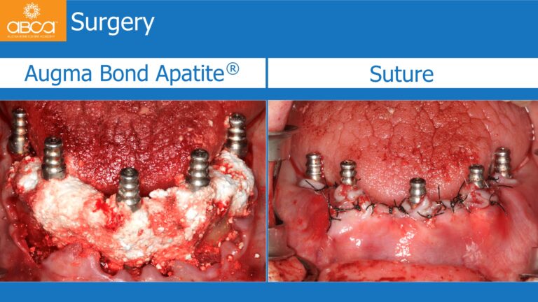 Mandible Full Arch Rehabilitation with an Immediate All-on-5 and Immediate Load