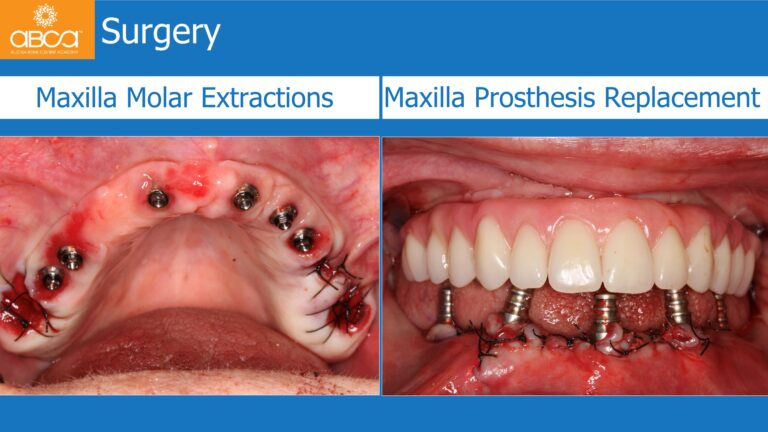 Mandible Full Arch Rehabilitation with an Immediate All-on-5 and Immediate Load