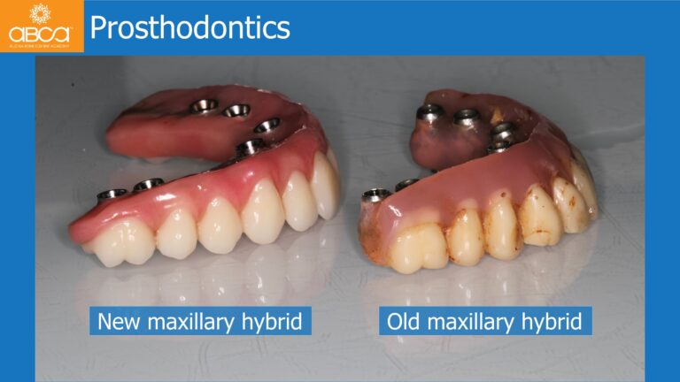 Mandible Full Arch Rehabilitation with an Immediate All-on-5 and Immediate Load
