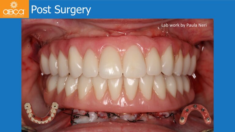 Mandible Full Arch Rehabilitation with an Immediate All-on-5 and Immediate Load