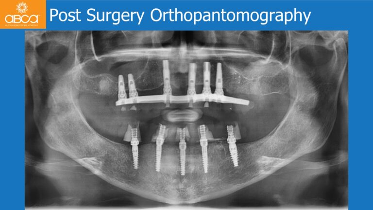 Mandible Full Arch Rehabilitation with an Immediate All-on-5 and Immediate Load