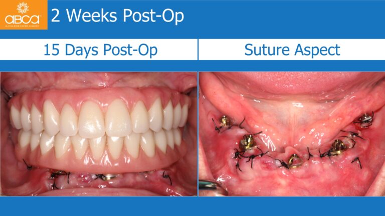 Mandible Full Arch Rehabilitation with an Immediate All-on-5 and Immediate Load
