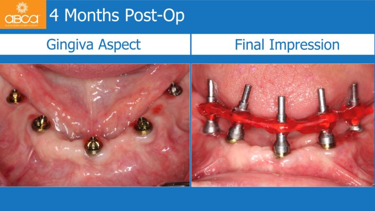 Mandible Full Arch Rehabilitation with an Immediate All-on-5 and Immediate Load