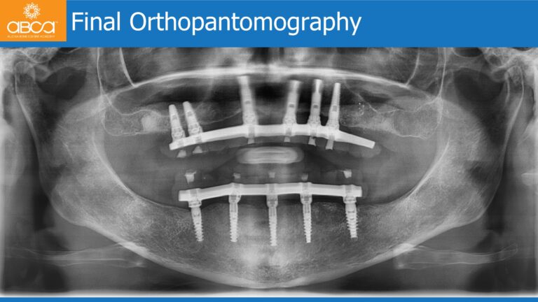 Mandible Full Arch Rehabilitation with an Immediate All-on-5 and Immediate Load