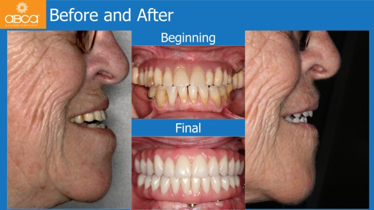 Mandible Full Arch Rehabilitation with an Immediate All-on-5 and Immediate Load