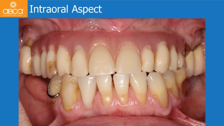 Mandible Full Arch Rehabilitation with an Immediate All-on-5 and Immediate Load