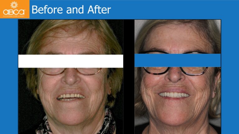 Mandible Full Arch Rehabilitation with an Immediate All-on-5 and Immediate Load