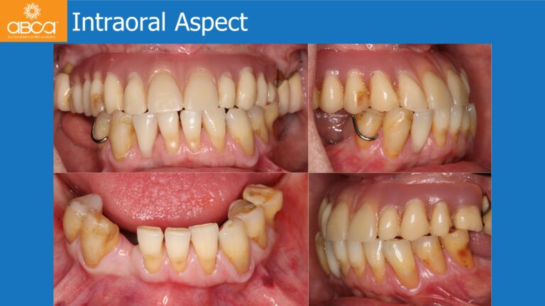 Mandible Full Arch Rehabilitation with an Immediate All-on-5 and Immediate Load