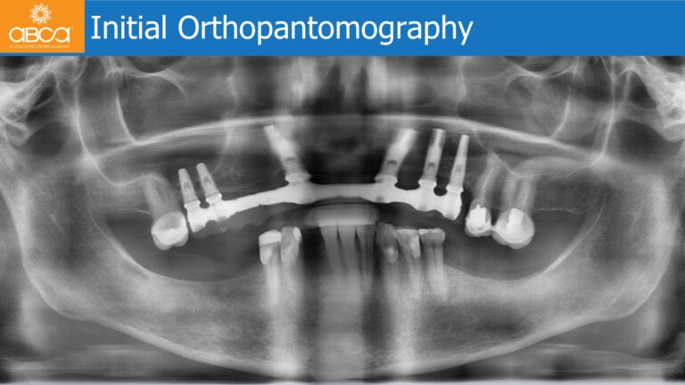 Mandible Full Arch Rehabilitation with an Immediate All-on-5 and Immediate Load