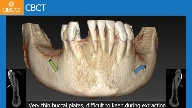 Mandible Full Arch Rehabilitation with an Immediate All-on-5 and Immediate Load