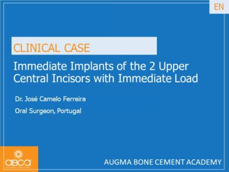 Immediate Implants of the 2 Upper Central Incisors with Immediate Load