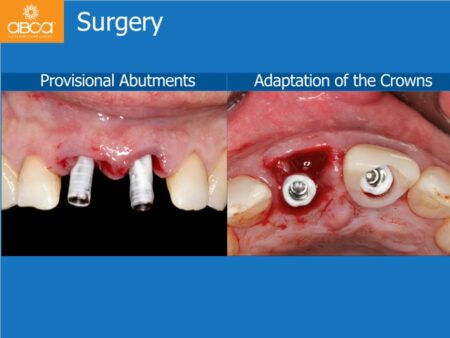 Immediate Implants of the 2 Upper Central Incisors with Immediate Load