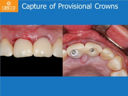 Immediate Implants of the 2 Upper Central Incisors with Immediate Load
