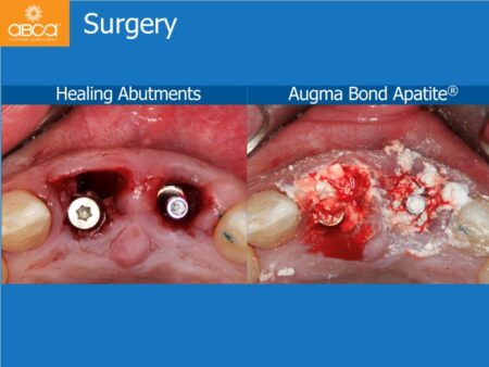 Immediate Implants of the 2 Upper Central Incisors with Immediate Load
