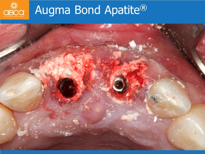 Immediate Implants of the 2 Upper Central Incisors with Immediate Load