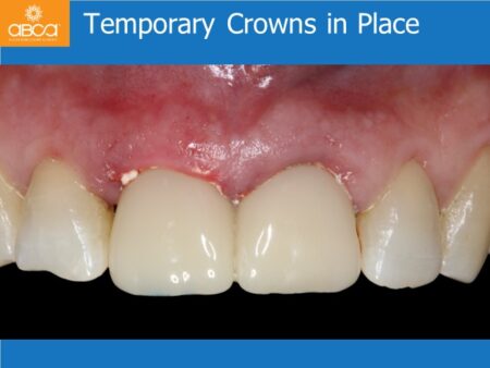Immediate Implants of the 2 Upper Central Incisors with Immediate Load
