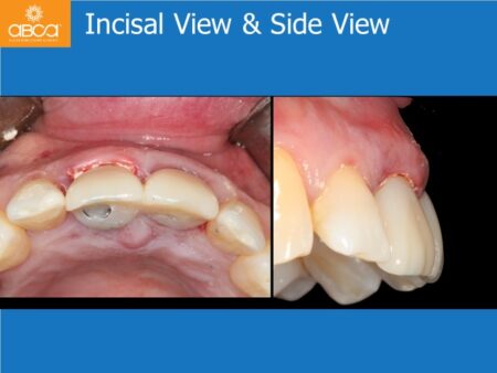 Immediate Implants of the 2 Upper Central Incisors with Immediate Load
